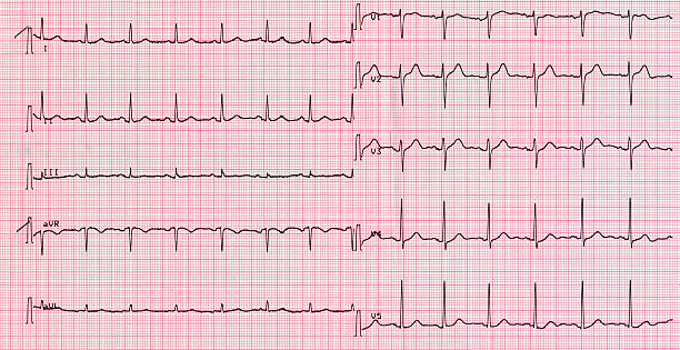 istock Electrocardiography of heart beat 181649676