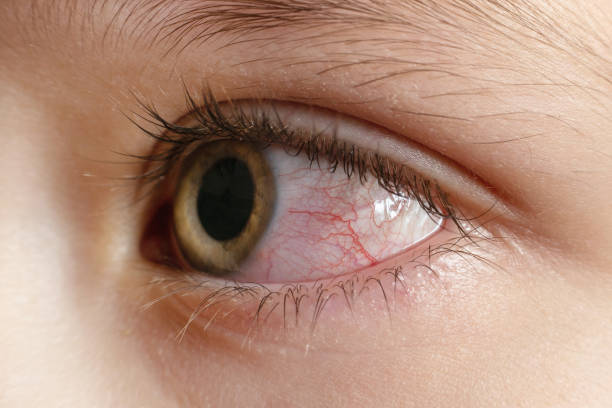 zbliżenie podrażnione zakażone czerwone oczy, zapalenie spojówek - conjunctivitis sore eyes child human eye zdjęcia i obrazy z banku zdjęć