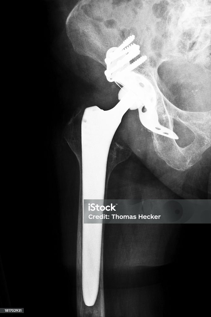 Искусственное тазобедренного сустава - Стоковые фото Radiogram - Photographic Image роялти-фри