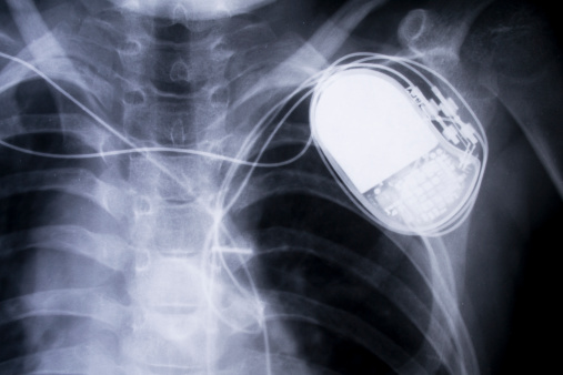 x-ray chestx-ray chest
