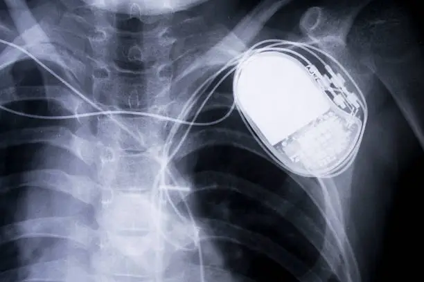 Photo of x-ray chest