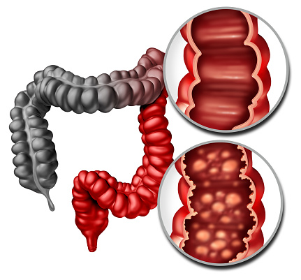 Ulcerative colitis as an inflammatory intestine with healthy and ulcerated inner bowel lining disease with a human rectum and colon as a digestive system and digestion concept with inflamed large intestines.