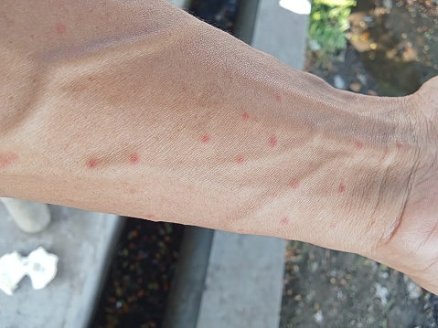 Mosquito bite marks on the skin are red