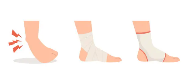 Vector illustration of Sprained ankle foot with elastic bandage and ankle support treatments.