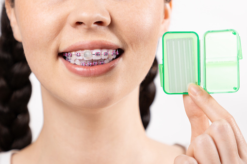 Close up of young Caucasian woman with brackets on teeth show little box with orthodontic wax. White background. Concept of dental care during orthodontic treatment.