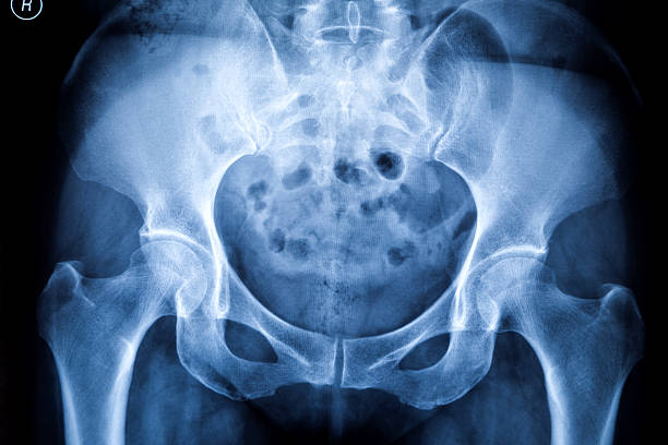 homem pélvis raio-x: a placa de onfh - cat scan pelvis hip human spine - fotografias e filmes do acervo