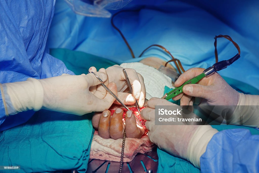 Mão de cirurgia - Royalty-free Aberto Foto de stock
