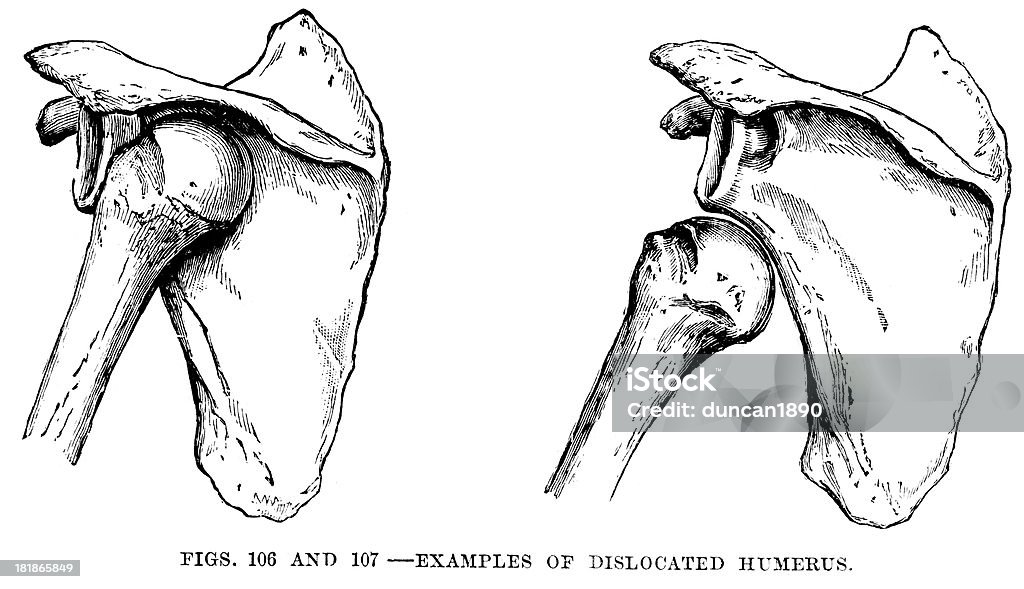 Dislocated húmero - Ilustración de stock de Hombro libre de derechos