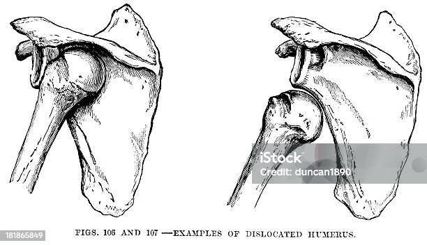 Dislocated Úmero - Arte vetorial de stock e mais imagens de Ombro - Ombro, Abdução do Ombro, Anatomia