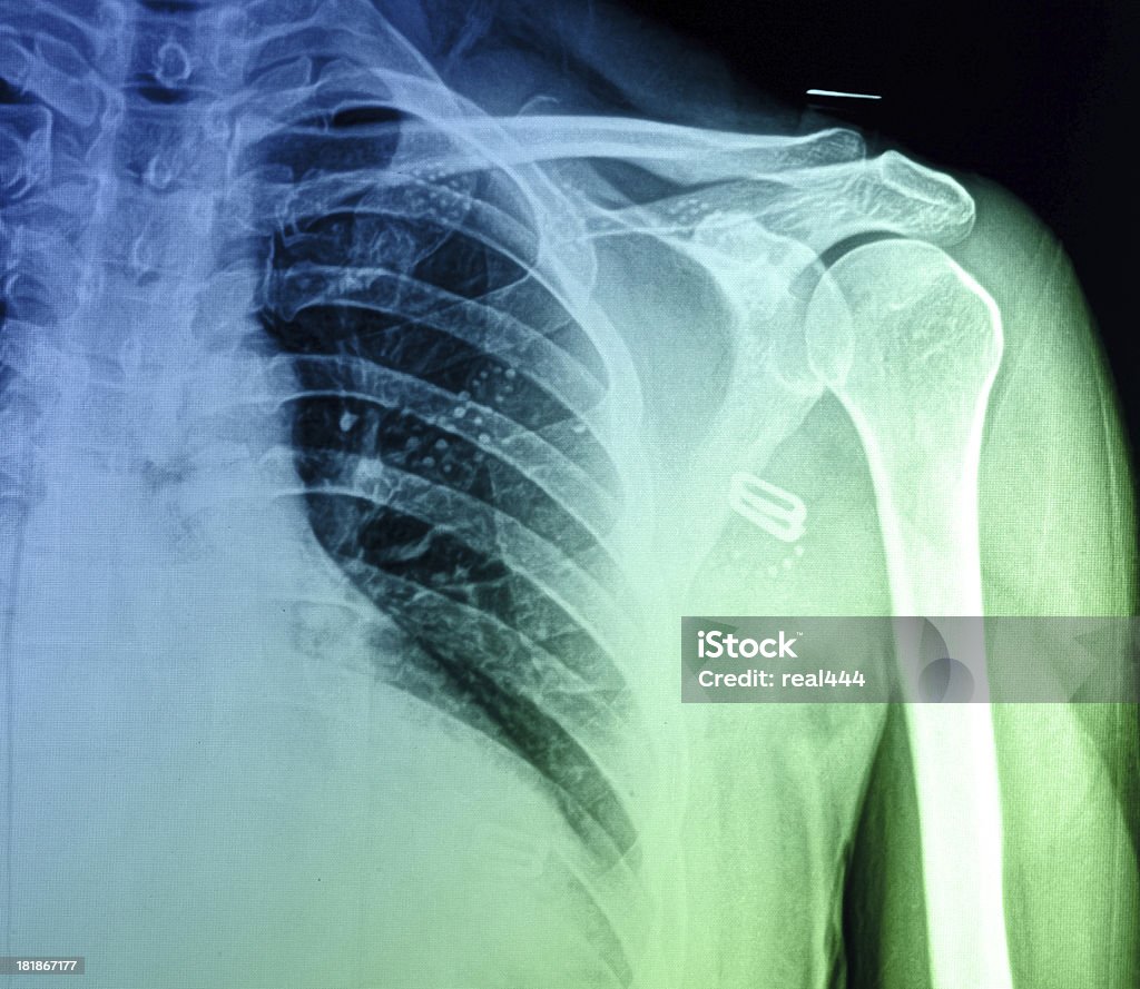 X-ray image de la poitrine. - Photo de Anatomie libre de droits