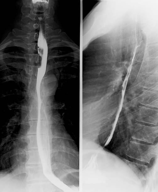 istock Esophagus with barium swallow 181871961