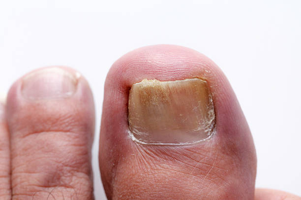 nagelpilz pilz-infektion auf nägel - fungus toenail human foot onychomycosis stock-fotos und bilder
