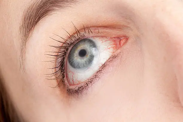 A macro image of a woman's irritated red eyeball wearing a contact.