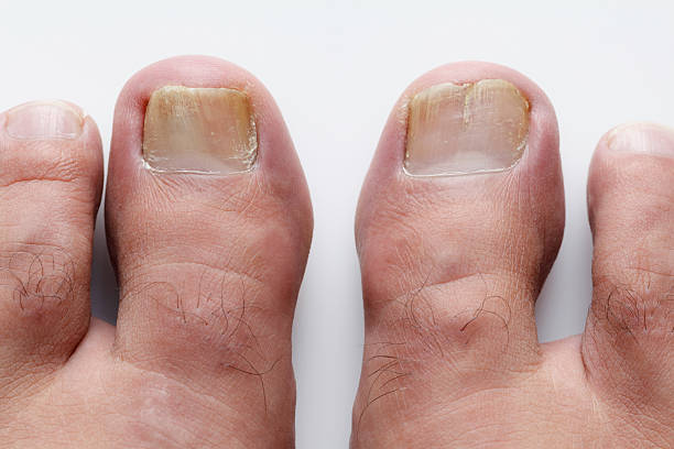 istock Onychomycosis fungus Infection on nails 181873619