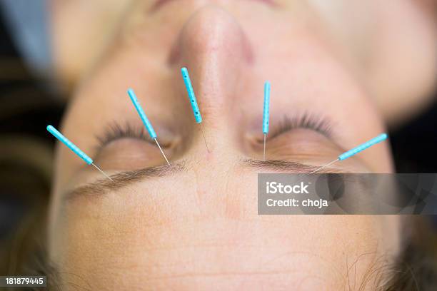 Tratamento De Acupunctura De Uma Mulher Jovem - Fotografias de stock e mais imagens de Acupuntura - Acupuntura, Face Humana, Primeiro plano