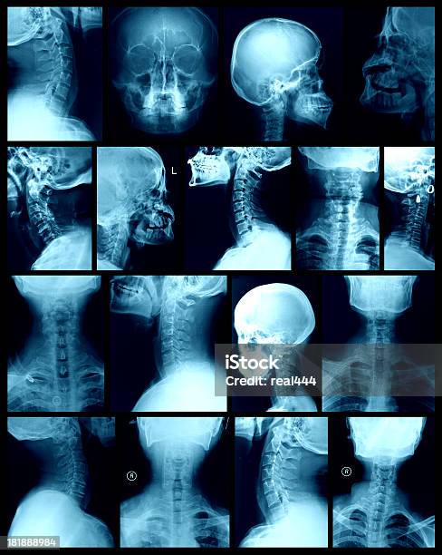 Cabeça Imagem De Raios X - Fotografias de stock e mais imagens de Anatomia - Anatomia, Articulação humana, Atributo Humano