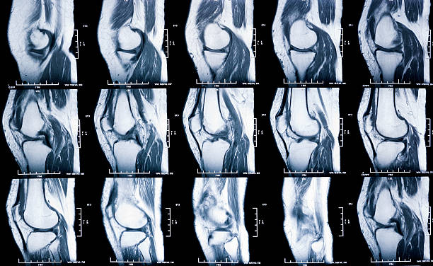 knee MRI - damage of cross and meniscus injury knee MRI - damage of cross and meniscus injury posterior cruciate ligament stock pictures, royalty-free photos & images