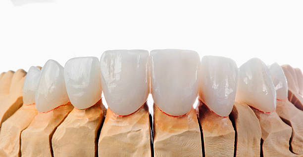 veneers dentale - laboratory dentures dental hygiene human teeth foto e immagini stock