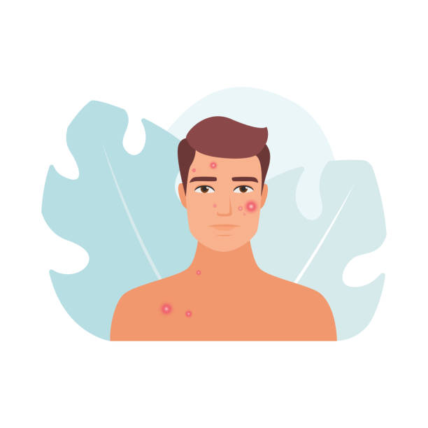 Sad worried man with acne problem and red pimples on face Sad worried man with acne problem and red pimples on face vector illustration acne-cartoon stock illustrations