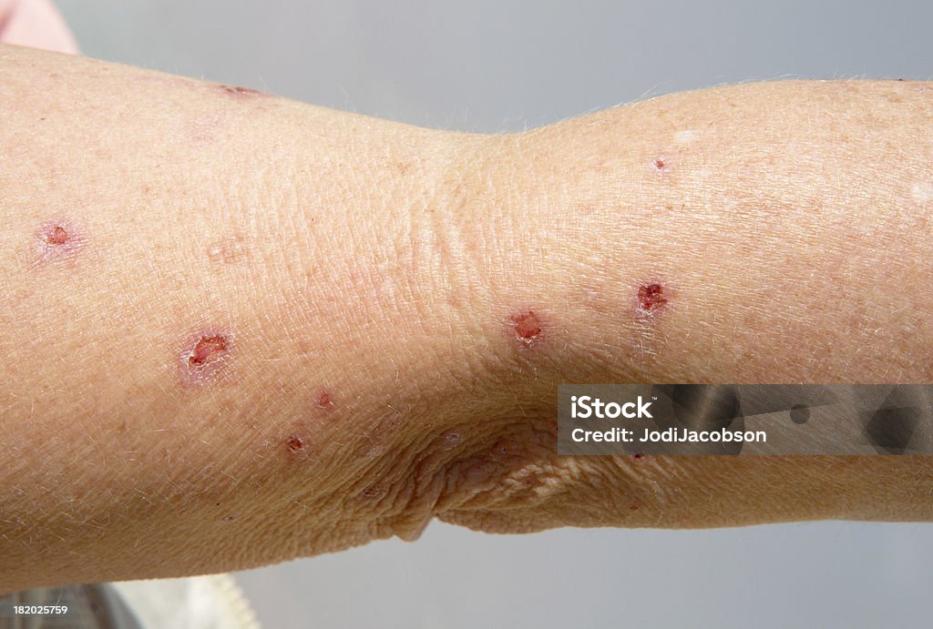 Медицинские: Везикулярная дерматит, солнце и perscription лекарственная реакция - Стоковые фото Аллергия роялти-фри