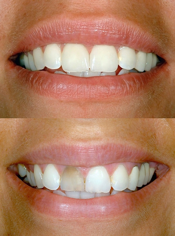 Before and after Smile design dental procedure photos . Selective soft focus.You can find more dental related images like this one here :