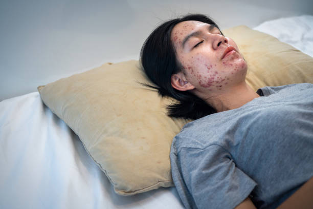 istock Pillows Cause Acne, Acne on Your face might be suffering when you rest your head upon your pillow night after night. 1820353429