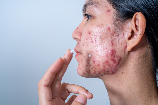 Acne on face because the disorders of sebaceous glands productions.  Acne or a Cosmetic Allergy. Hormonal changes and Foods Cause Symptoms of Skin Allergies