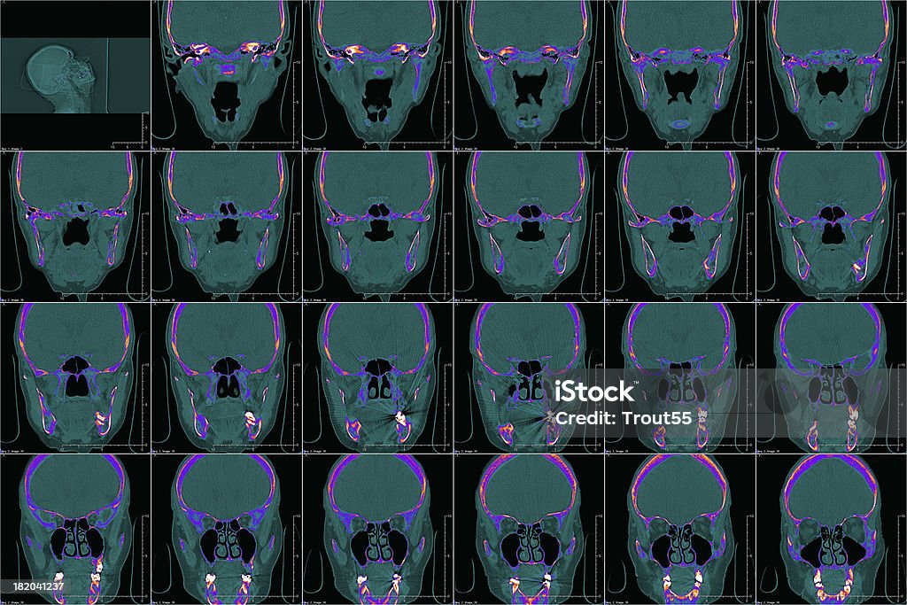 Cabeza (oído interno en color de CT - Foto de stock de Actividad libre de derechos