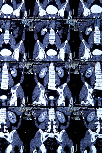 istock Spine and kidney mri 182077179