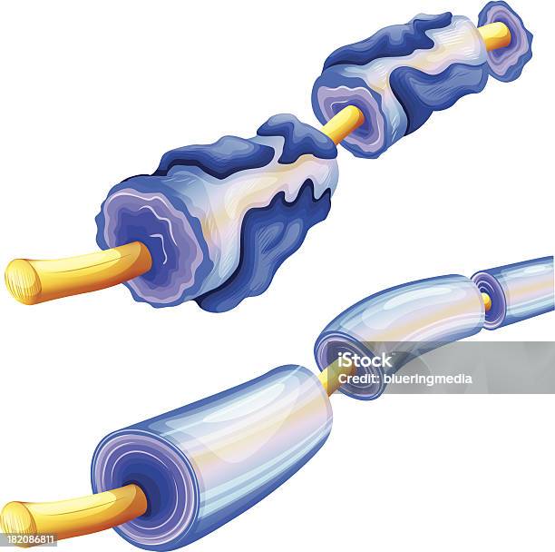 Mielina Deterioração - Arte vetorial de stock e mais imagens de Medula - Parte de organismo vivo - Medula - Parte de organismo vivo, Sistema Nervoso Humano, Axónio