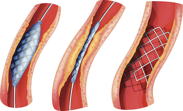 ilustraciones, imágenes clip art, dibujos animados e iconos de stock de endoprótesis utiliza para abrir arterias bloqueadas - angioplasty