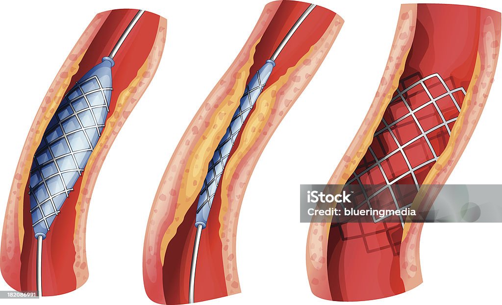 Stent used to open blocked artery Stent used to open blocked artery on a white background Stent stock vector