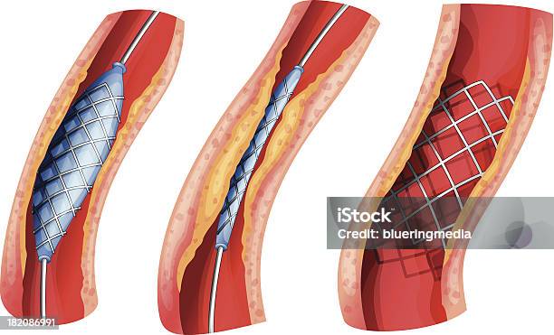 Stent Used To Open Blocked Artery Stock Illustration - Download Image Now - Stent, Angioplasty, Blood Clot