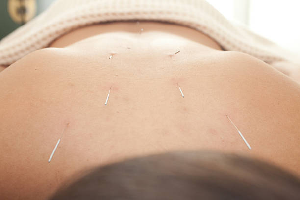istock patient receives acupuncture therapy at a clinic 182106325