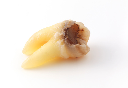 tooth with dental caries