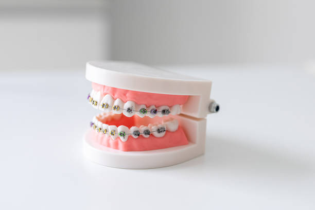 歯列矯正装置と義歯を備えたプラスチック製の歯科用模型