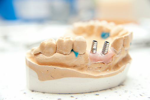 Dentist matching the right white tone for a dental crown using a color swatch palette.