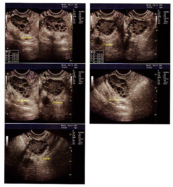 Ovarian Cysts Ultrasound showing typical ovarian cysts during Polycystic Ovarian Syndrome (PCOS) polycystic ovary syndrome photos stock pictures, royalty-free photos & images