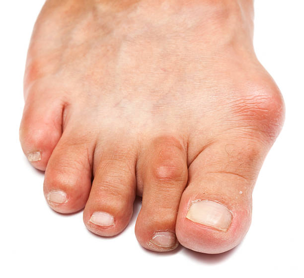 Deformed Foot  - Bunion "Macro shot of a deformed foot in bad condition. A huge bone extrusion (bunion) just  above the big toe, with some callosity visible as well. Focus on the big toe. (Canon 5D Mark II, Adobe RGB)" deformed stock pictures, royalty-free photos & images