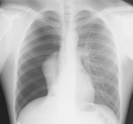 x-ray of pneumothorax of the right lung