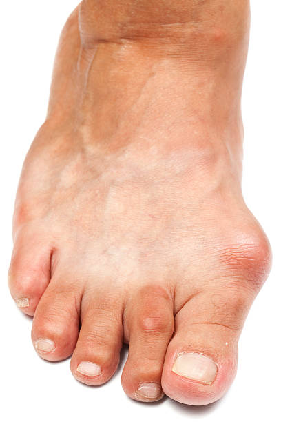 변형된 발-엄지발가락굽음증 - bunion bunions human foot podiatry 뉴스 사진 이미지