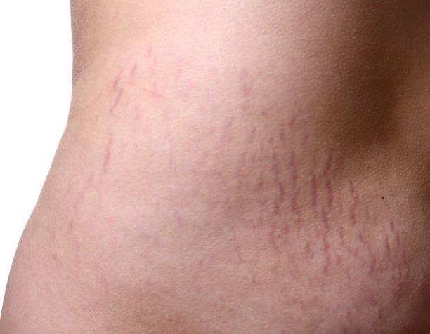 Stretch Marks Stretch Marks on human skinSEE ALSO: stretch marks stock pictures, royalty-free photos & images