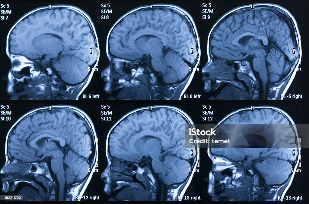 뇌 MRI 스캔 - 로열티 프리 뇌 스톡 사진