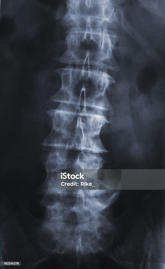 X-ray d'un disque herniation avec lombaire - Photo de Hernie discale libre de droits