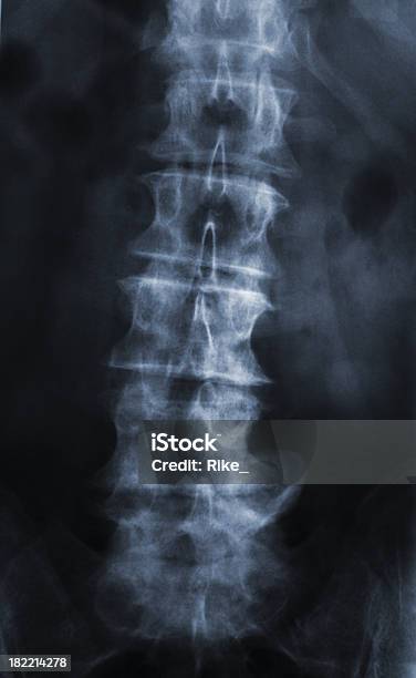 Photo libre de droit de Xray Dun Disque Herniation Avec Lombaire banque d'images et plus d'images libres de droit de Hernie discale - Hernie discale, Imagerie par rayons x, Rayon X