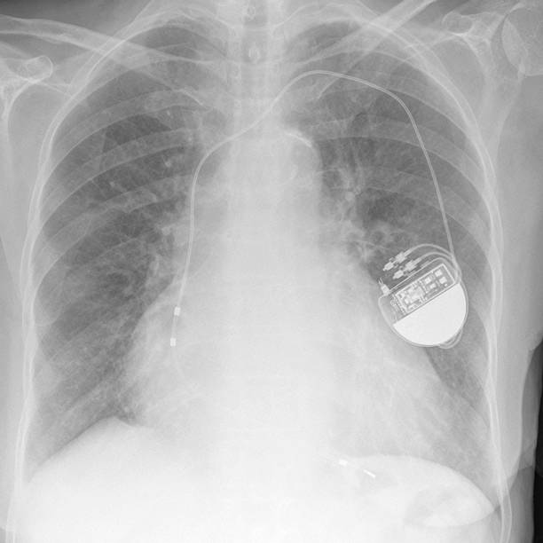 istock digital chest x-ray of a pacemaker and large heart 182238643