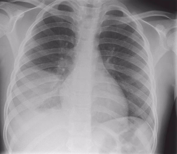 digital peito raio-x de uma criança com pneumonia - foto de acervo