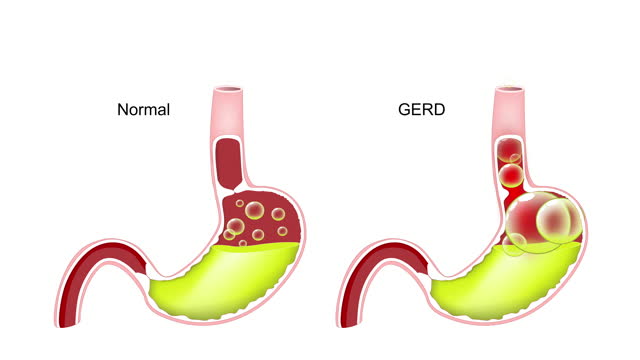 Gastroesophageal reflux disease. GERD.