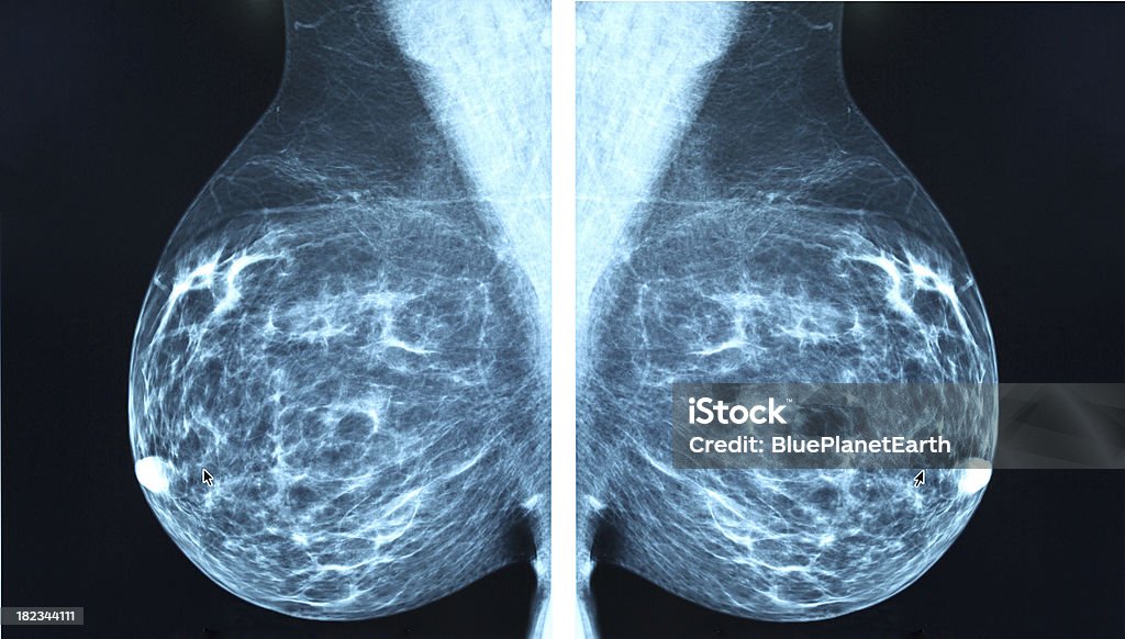 Mammografia radio imagingr diagnosi di carcinoma mammario - Foto stock royalty-free di Mammografia