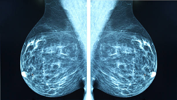 mammografia radio imagingr diagnosi di carcinoma mammario - medical scan immagine foto e immagini stock